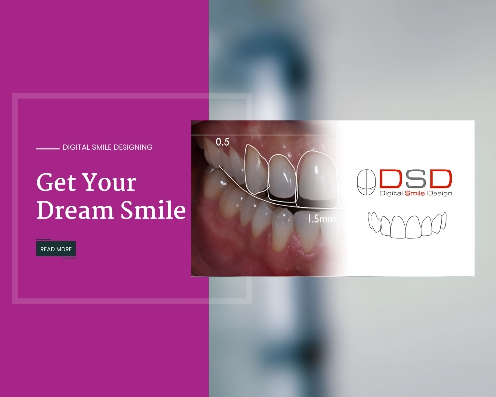 DSD - Digital Smile Design 